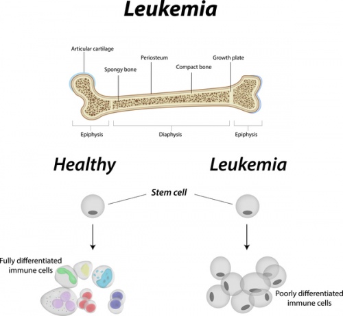 Abnormal-blood-cell-development-in-leukemia.jpeg