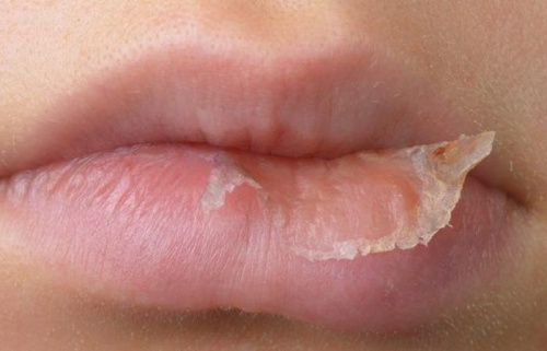 How To Treat Cheilitis Lips 